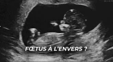 Fœtus à l’envers ? Le conseil du Steipeler
