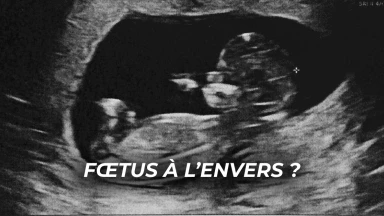 Fœtus à l’envers ? Le conseil du Steipeler